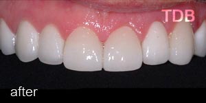 dental porcelain veneers