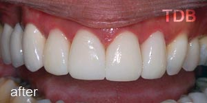 dental veneers