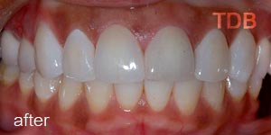 ceramic veneers