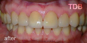 porcelain veneers