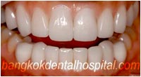 dental makeover : dental veneers