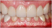 dental makeover : dental veneers