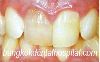 dental makeover : dental veneers