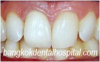 dental makeover : dental veneers