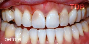 dental veneers