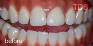 ceramic veneers