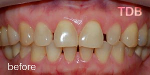 porcelain veneers