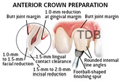 e.max anterior crown preparation