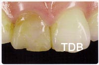 IPS e.max crown before treatment