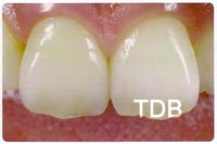 IPS e.max crown after treatment