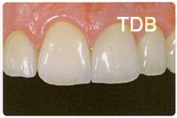 IPS e.max crown after treatment