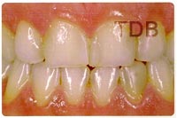 IPS e.max veneer