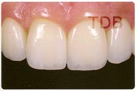 IPS e.max veneer