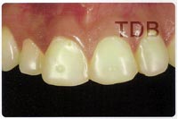 IPS e.max ZirCAD/IPS e.max Ceram veneer