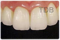 IPS e.max ZirCAD/IPS e.max Ceram veneer