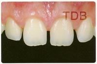 IPSIPS e.max Press/IPS e.max Ceram veneer