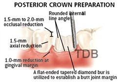 e.max posterior crown preparation