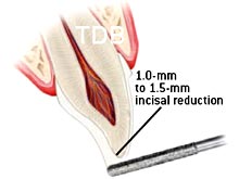 e.max veneer incisal preparation