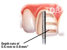 e.max veneer preparation