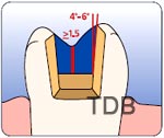 IPS empress esthetic inlay preparation