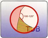 IPS empress esthetic inlay preparation