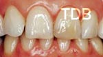 ips empress veneers