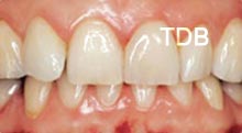 ips empress veneers