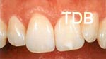 ips empress veneers