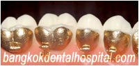 iBraces Lingual Orthodontic, Custom Lingual Orthodontic