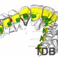 ibraces lingual procedure in ibraces Bangkok, ibraces Thailand