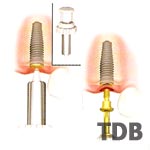 Implant Two-Stage Delayed Function
