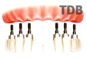 Implant all missing teeth with Procera Implant Bridge