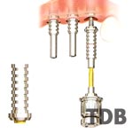 Immediate implant Function - Multiple Restorations