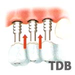 Immediate implant Function - Multiple Restorations in dental thailand