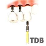 Immediate implant Function - Multiple Restorations with implant center