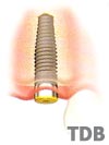Dental Implant in Bangkok Thailand