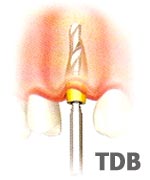 Implant Placement at the Time of Extraction