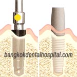 flapless procedure implant bangkok