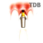 One Day implant with Esthetic Abutment, Procera Crown and NobelRondo