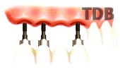 Several Implant with Procera Implant Bridge