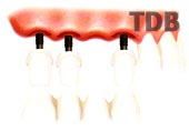 Several Implant with Procera&reg; Abutment Zirconia, Procera Bridge Zirconia and NobelRondo
