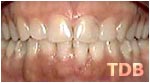 Invisalign Thailand after