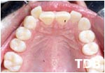 Invisalign Thailand before