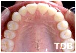 Invisalign Thailand after