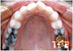 Invisalign Thailand before