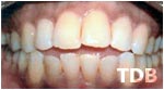 Invisalign Thailand before