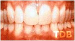 Invisalign Thailand after