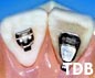 light lingual orthodontics braces in bangkok thailand