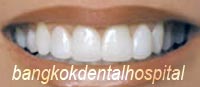 After Lumineers veneer treatment