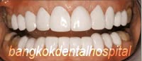 After Lumineers veneer treatment